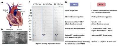 Left bundle branch area pacing: A promising modality for cardiac resynchronization therapy